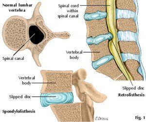 Shoulder Pain