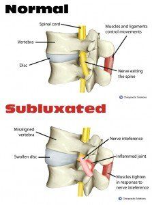 Subluxation Treatment Farmington Chiropractor