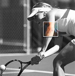 Tennis Elbow