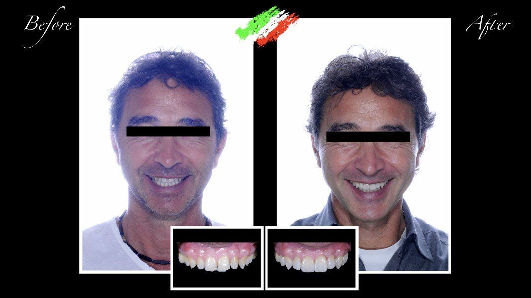 Impianto dentale