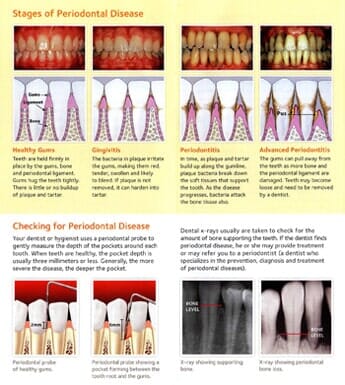 Periodontal Disease Stages — Tooth Extraction in Wausau, WI Periodontal Disease Stages — Tooth Extraction in Wausau, WI