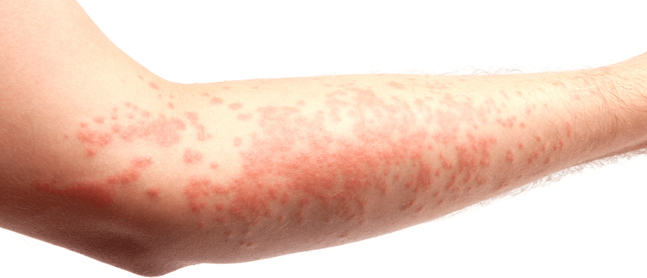 A close up of a person 's arm with red spots on it.