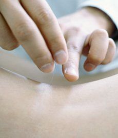 acupuncture treatment acupuncture treatment