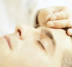 acupuncture treatment