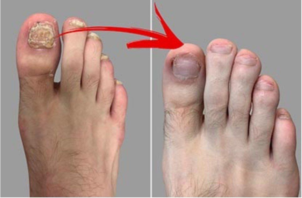 Child's Heel — Indianapolis, IN — Ladine Podiatry