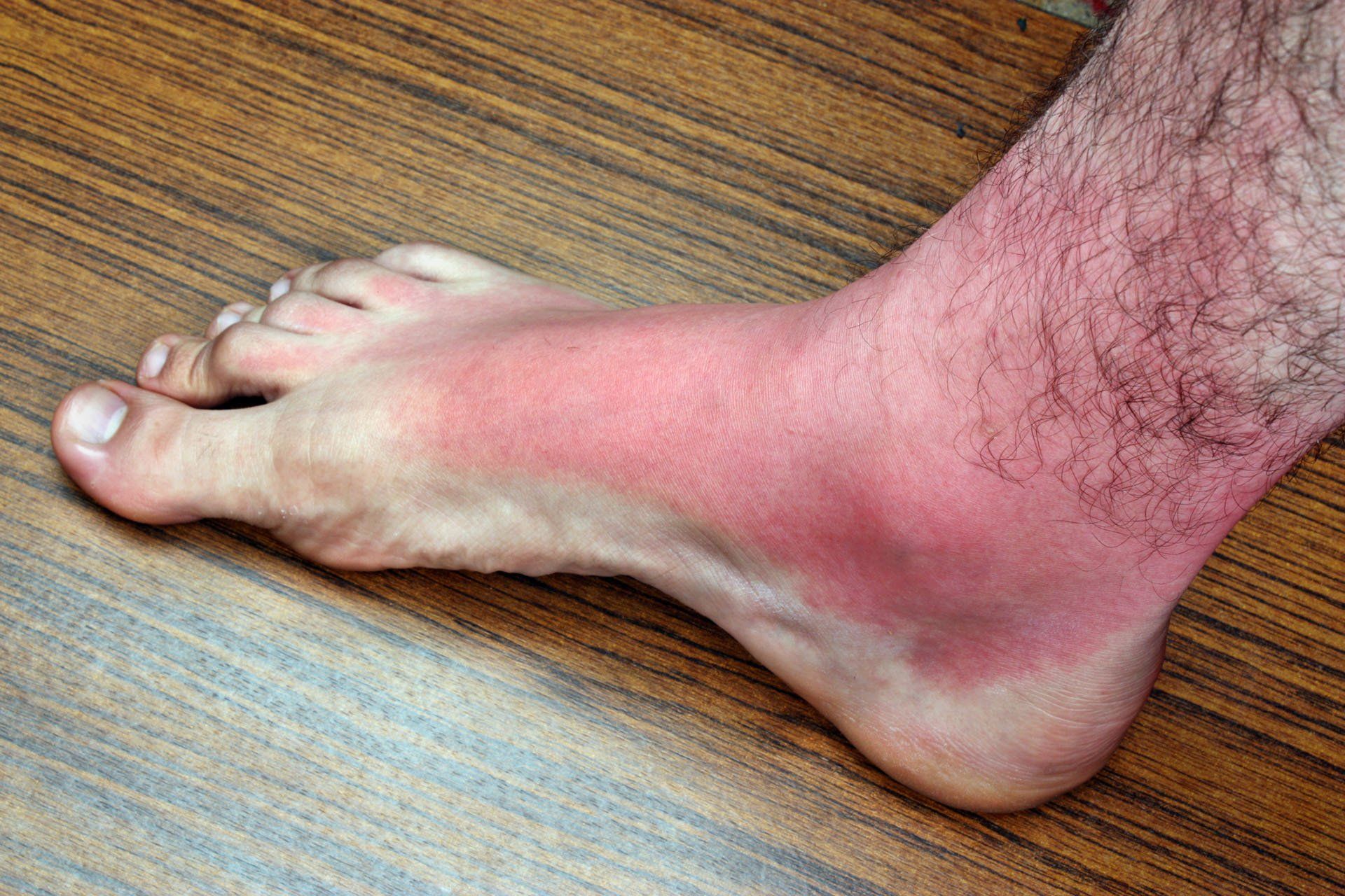 Burned Feet — Alexander City, AL — C & M Enterprise, Inc.
