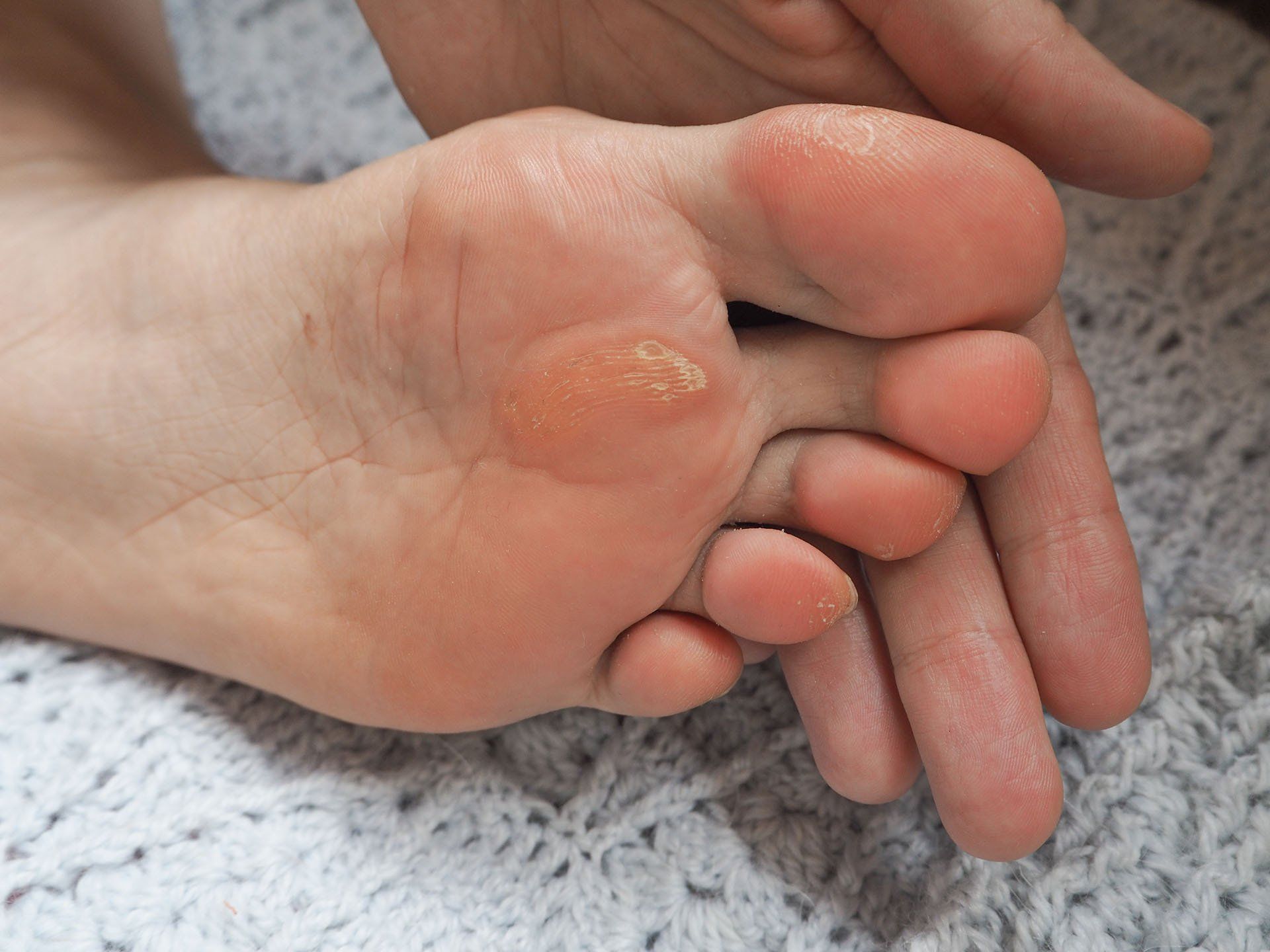 Foot with Calluses — Alexander City, AL — C & M Enterprise, Inc.