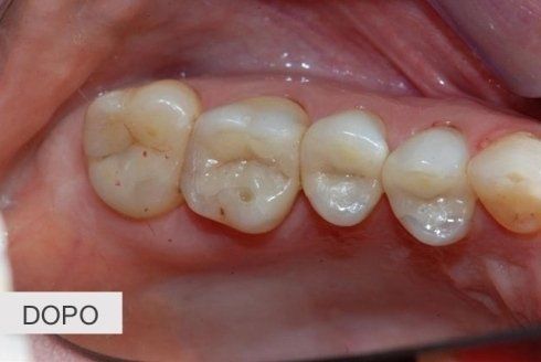 denti cariati