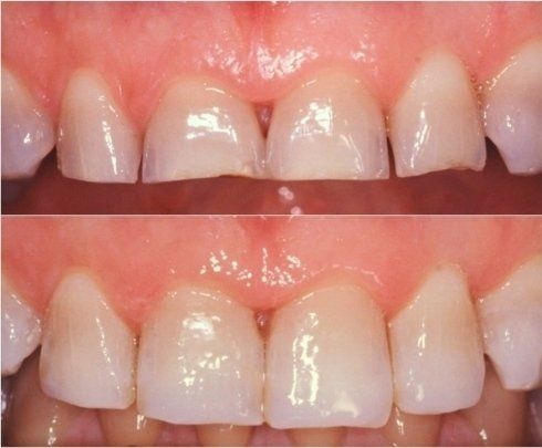 prima e dopo pulizia denti