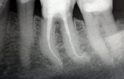 radiografia dente