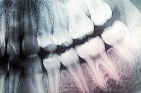 radiografia denti