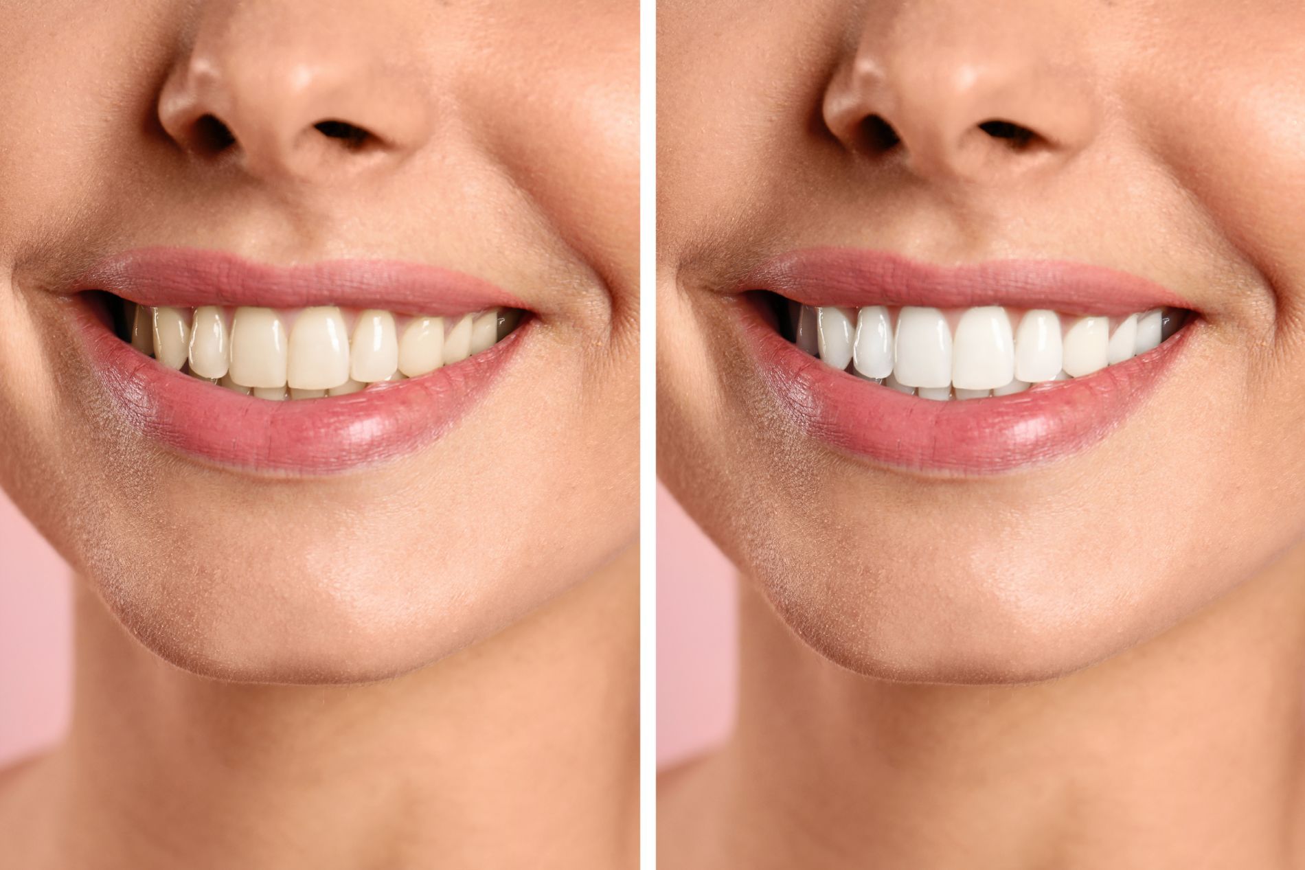 prima e dopo sbiancamento dentale