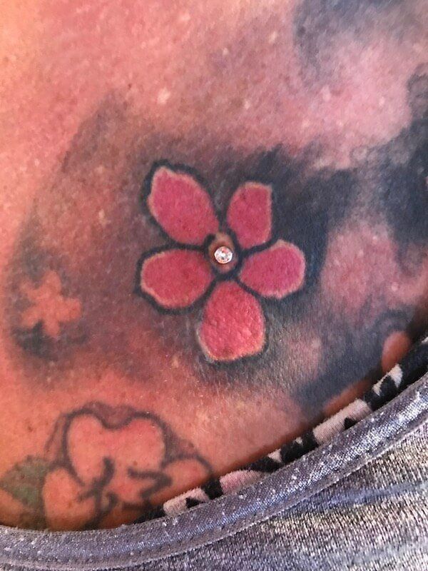 dermal implant kansas sity