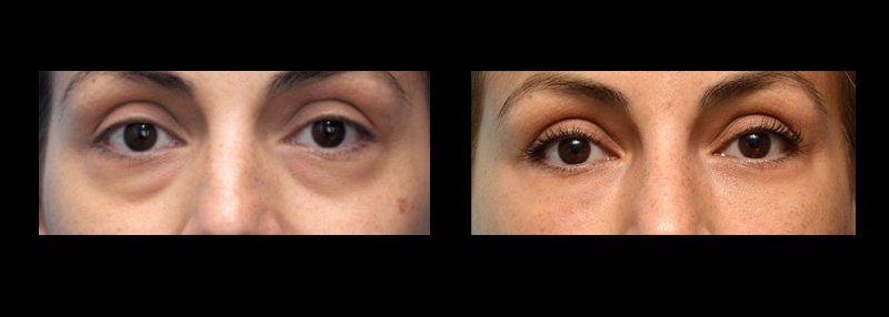 blefaroplastia en chihuahua