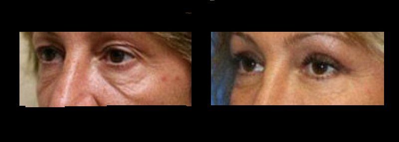 blefaroplastia en chihuahua