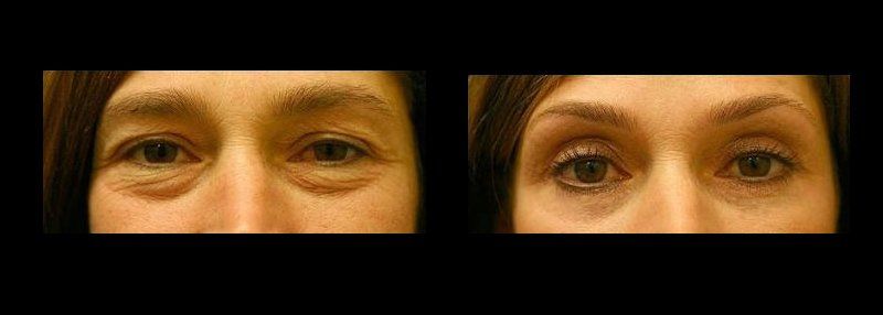 blefaroplastia en chihuahua