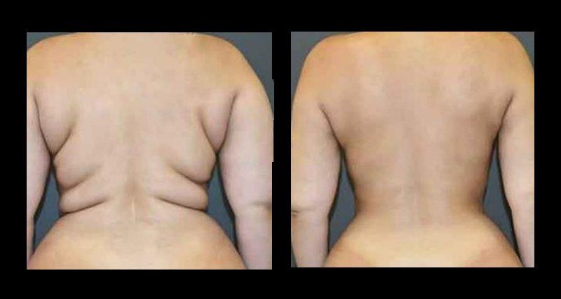 lipoescultura en chihuahua