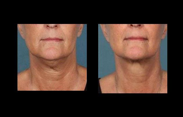 lipoescultura facial en chihuahua