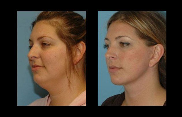 lipoescultura facial en chihuahua