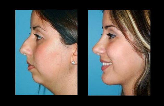 lipoescultura facial en chihuahua