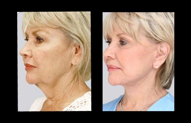 lipoescultura facial en chihuahua