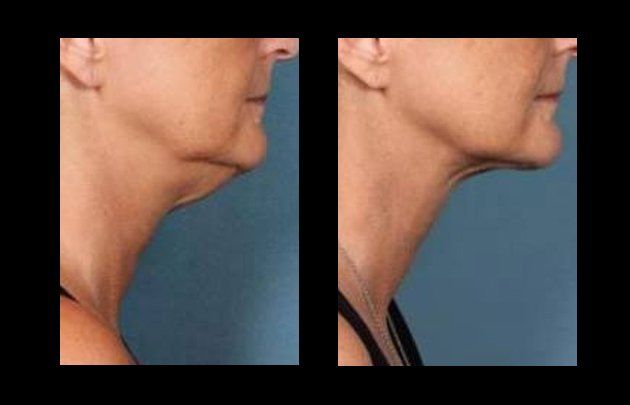 lipoescultura facial en chihuahua