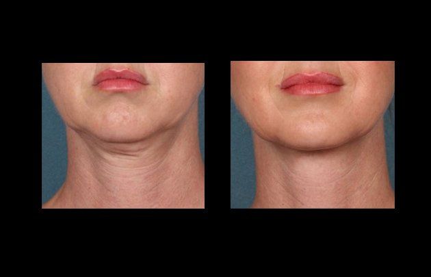 lipoescultura facial en chihuahua