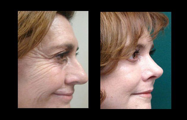 rejuvenecimiento facial en chihuahua