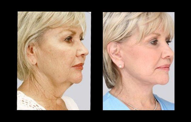 rejuvenecimiento facial en chihuahua
