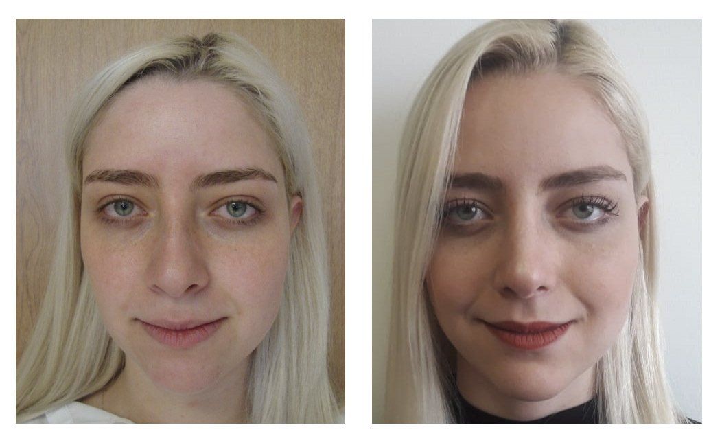 rinoplastia en chihuahua