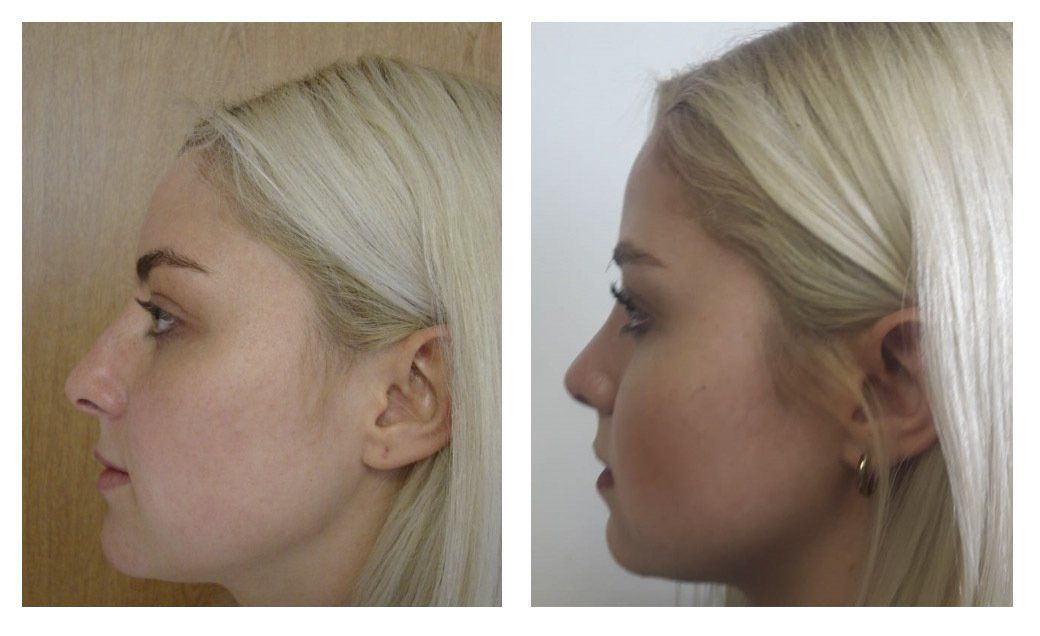 rinoplastia en chihuahua