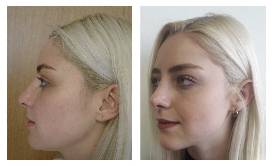 rinoplastia en chihuahua