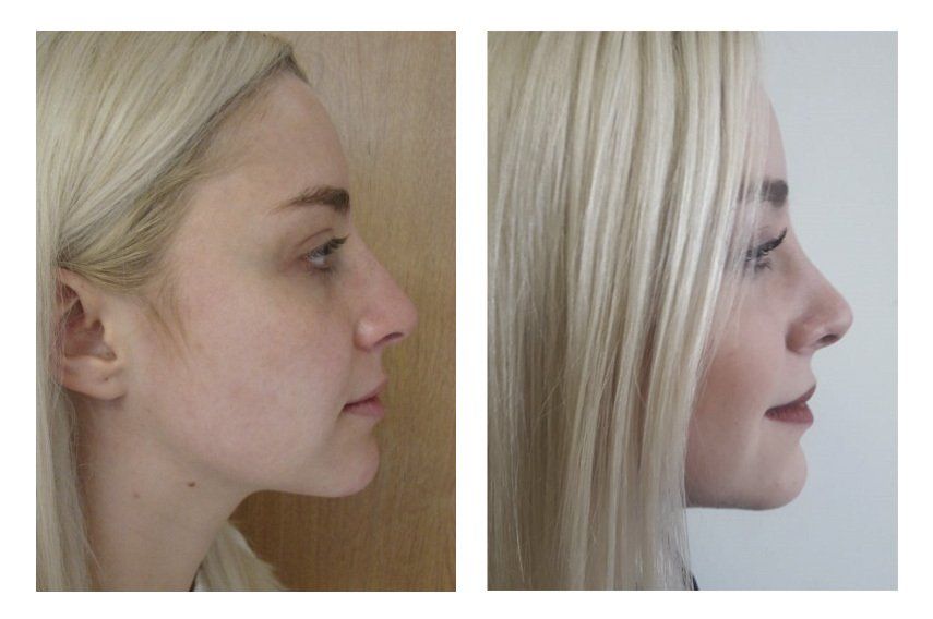 rinoplastia en chihuahua