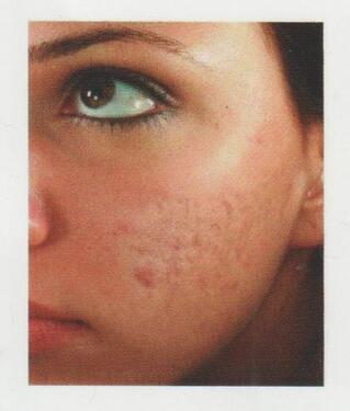 Microneedling Before — White Oak, PA — Elegante Details