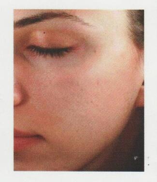 Microneedling After — White Oak, PA — Elegante Details