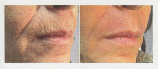 Microneedling Before and After — White Oak, PA — Elegante Details Microneedling Before and After — White Oak, PA — Elegante Details