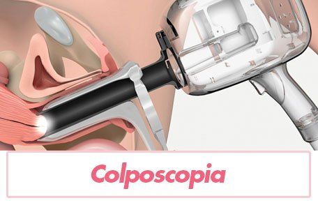 colposcopia