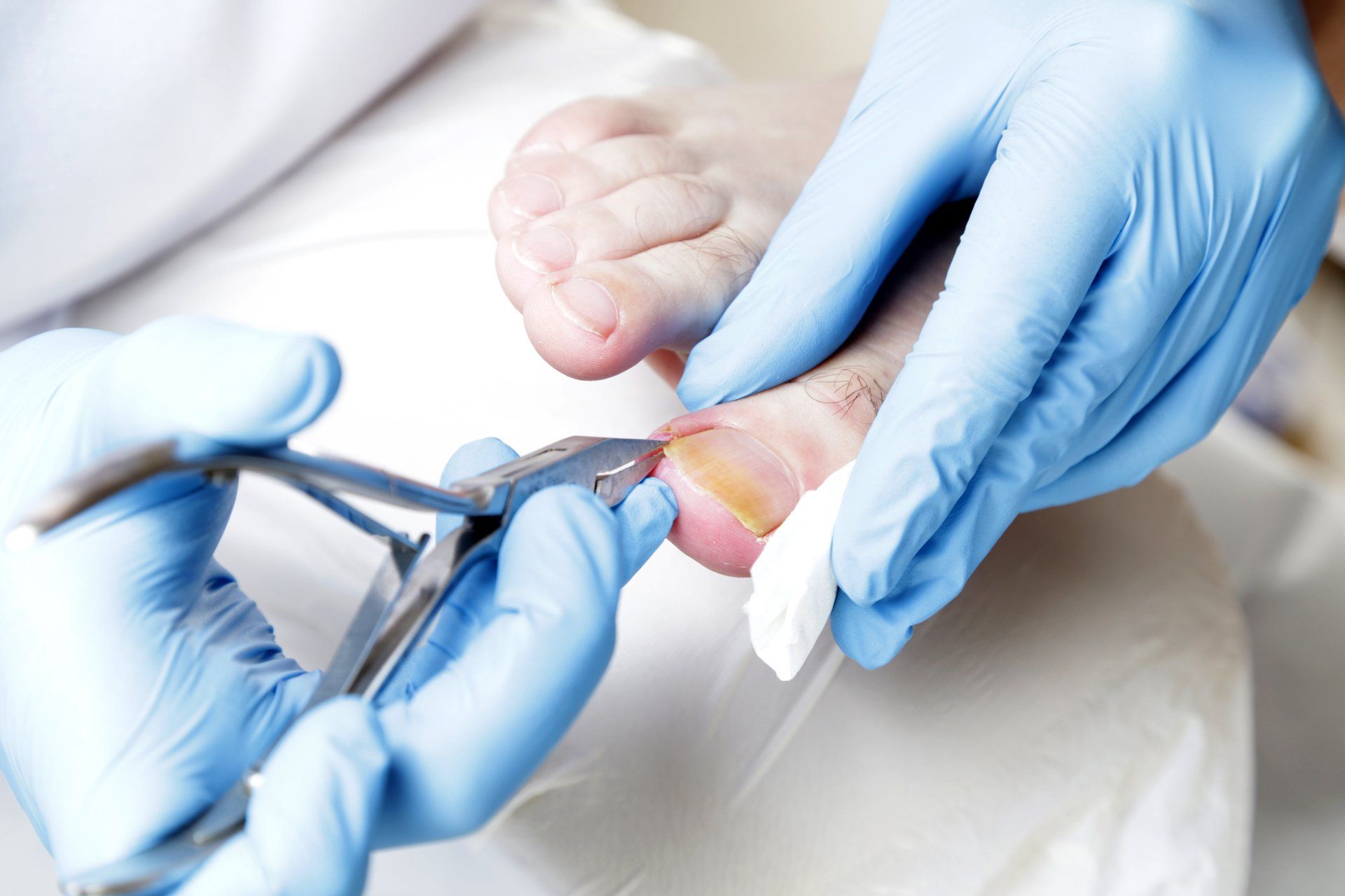 Tratamento cirúrgico para unhas dos pés