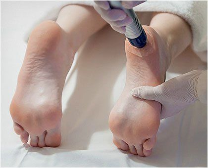 Callus treatment