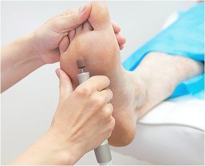 Foot corn removal