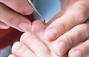 Verruca treatments