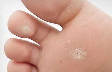 Verruca needling