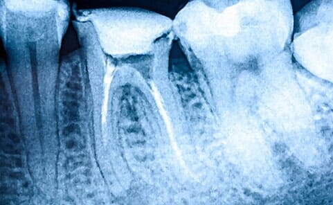 Root Canal - Root Canal Therapy in Farmingdale, NY Root Canal - Root Canal Therapy in Farmingdale, NY