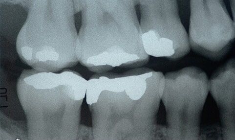 X-ray teeth - Crowns Bridges in Farmingdale, NY X-ray teeth - Crowns Bridges in Farmingdale, NY