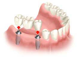 Dental Implant
