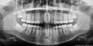 Oralchirurgie Mannheim: Weisheitszahnentfernung und mehr