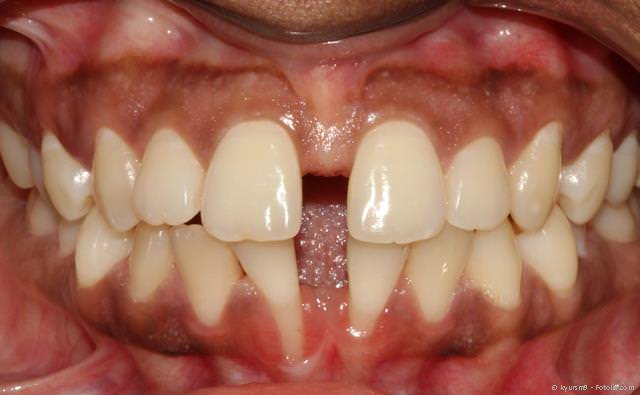 Sog. Diastema (Zahnlücke) bei stark ausgeprägtem Lippenband Sog. Diastema (Zahnlücke) bei stark ausgeprägtem Lippenband