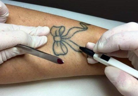 Sessione di epilazione con elettrocoagulazione