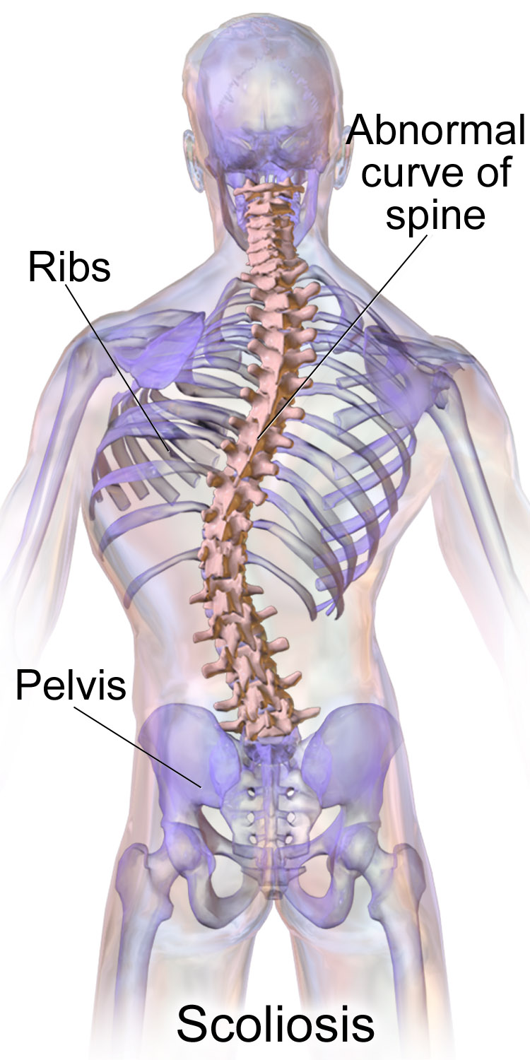 scoliosis therapy silver spring md
