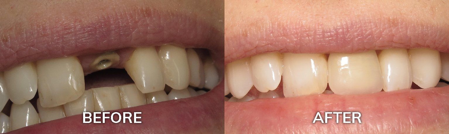 Before and After Dental Implants | Restorative and Cosmetic Dentist Tuscaloosa AL 35401
